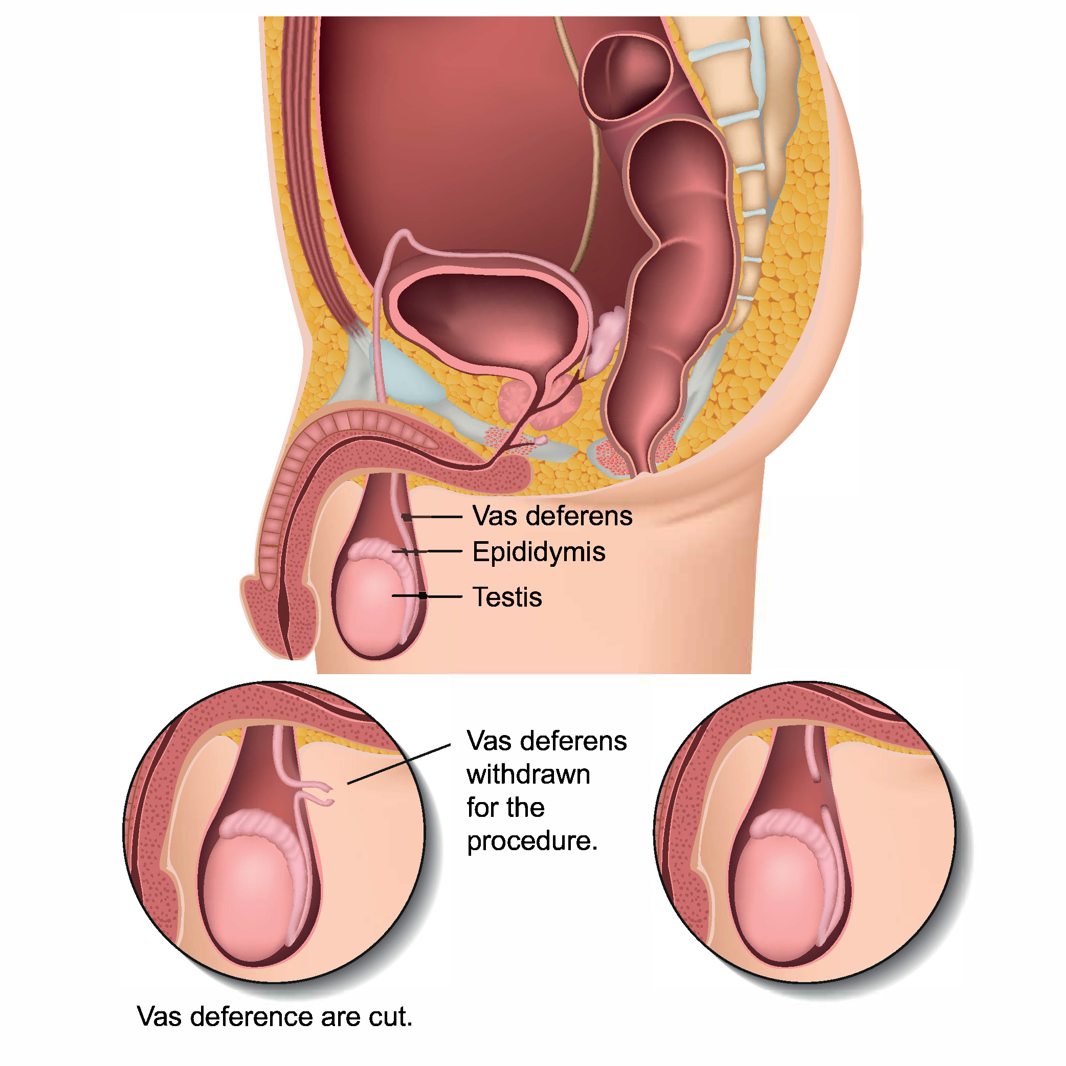 정관수술 중 정관이 절단되는 위치에 대한 그림