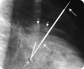미세석회화 환자의 모습.