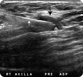 가는 바늘 흡인입니다.