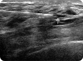 흡인 후의 유방.