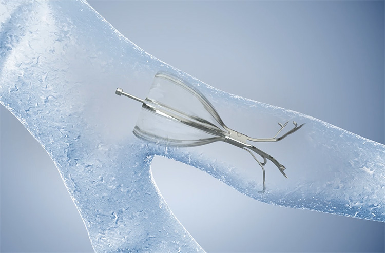 기도를 통해 이동하는 올림푸스 흡출 밸브